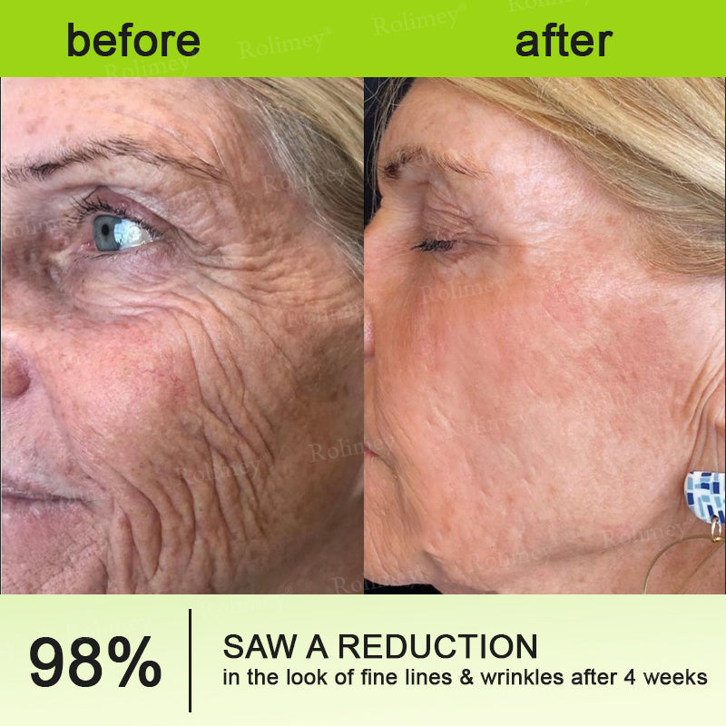 Final 3 Hours: 70%OFF🔥 QIAWITM Botulinum & Vita-A Retinol Shot Wrinkle-Lift Tightening cream✨