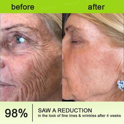 Final 3 Hours: 70%OFF🔥 QIAWITM Botulinum & Vita-A Retinol Shot Wrinkle-Lift Tightening cream✨